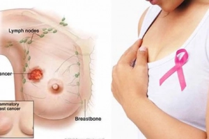 Sau áp xe tuyến sữa có bị mất sữa? Có cho con bú tiếp được không?