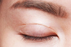 Sau khi cắt chỉ mí mắt có bôi thuốc mỡ không?