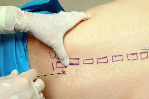 Sau khi gây tê tủy sống mổ thoát vị bẹn có bị đau lưng không?