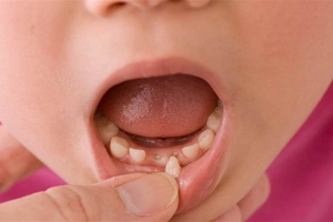 Sau khi nhổ răng sữa nên làm gì?