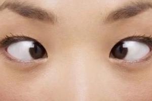Sau mổ đục thủy tinh thể bao lâu có thể chỉnh lé?