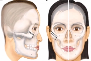 Sau phẫu thuật gãy xương gò má và gãy mỏm vẹt khó há miệng nên làm gì?