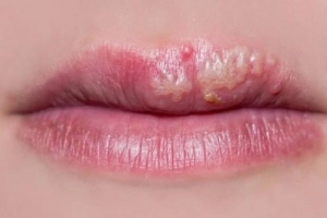 Sau xăm môi bị rộp môi uống thuốc gì?