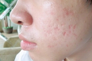 Sẹo lõm do thủy đậu điều trị thế nào?
