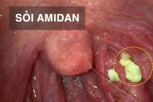 Sỏi amidan và cách chữa trị để hết hôi miệng