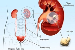 Sỏi niệu quản 12mm kèm viêm có nên phẫu thuật không?