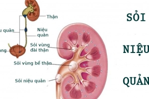 Sỏi niệu quản kèm ói mửa điều trị thế nào?