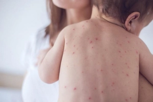 Sốt phát ban phải làm sao? Nguyên nhân gây sốt phát ban thường gặp