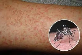 Sốt xuất huyết kèm ho, ngứa họng có sao không?