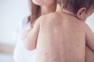 Sốt xuất huyết ở trẻ em có nguy hiểm không?