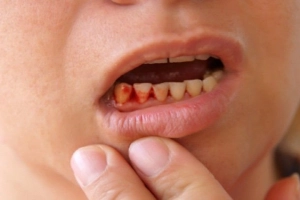 Sưng kèm chảy mủ lợi sau té đập răng phải làm sao?