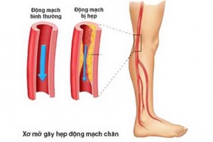 Tắc động mạch nuôi chi cấp tính có nguy hiểm?