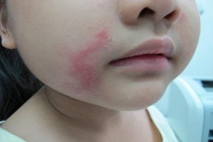 Tác hại khi bị kiến ba khoang cắn