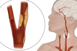 Tắc hoàn toàn động mạch cảnh trái phải điều trị thế nào?