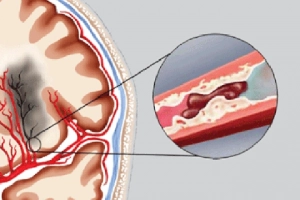 Tắc mạch máu não có hồi phục được không?