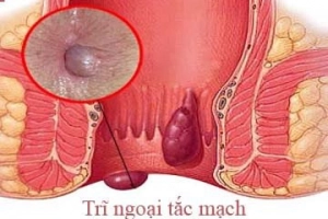 Tắc mạch trĩ là gì ? Điều trị như thế nào?