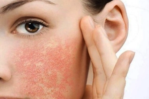 Tại sao da mặt bị ngứa thường xuyên?