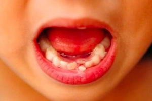 Tại sao răng sữa chưa rụng đã mọc răng mới?