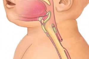 Teo thực quản: Bệnh phổ biến của teo đường tiêu hóa