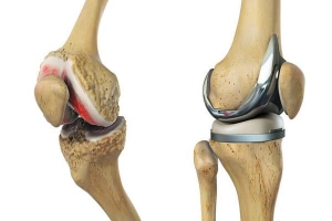 Thay khớp nhân tạo - Giải pháp tối ưu khi thoái hóa khớp nặng