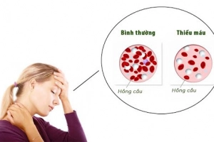 Thiếu máu thiếu sắt ảnh hưởng thế nào tới sức khỏe?