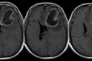 Thông tin về Gliomas (u thần kinh đệm) ở người lớn