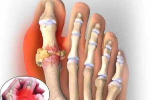 Thực phẩm tốt và tệ nhất cho người bị bệnh gút