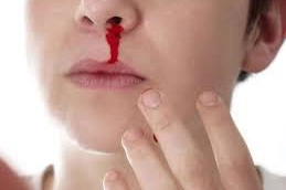 Thường xuyên chảy máu mũi là dấu hiệu của bệnh gì?