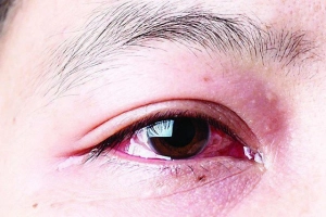 Thường xuyên đau nhức mắt kèm đỏ điều trị được không?
