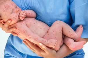 Thủy đậu ở trẻ sơ sinh