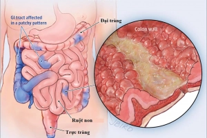 Tiên lượng và điều trị bệnh Crohn