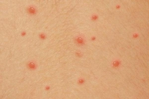 Tiếp xúc với người mới mắc thủy đậu có lây nhiễm không?