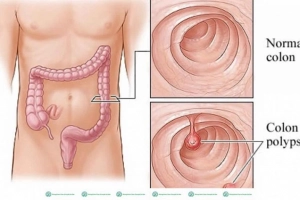 Tìm hiểu: Bệnh Adenoma là gì