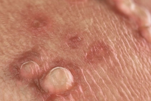 Tìm hiểu các loại mụn sinh dục ở nam và nữ