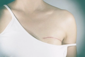 Tìm hiểu về hiện tượng tăng sản không điển hình của vú