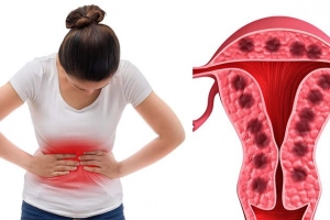 Tìm hiểu về lạc nội mạc trong cơ tử cung