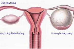 Tìm hiểu về u nang buồng trứng lành tính