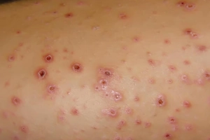 Tổng quan về bệnh á vảy nến và vảy phấn dạng lichen