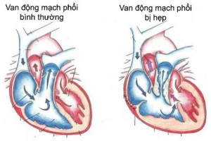 Tổng quan về bệnh Hẹp van động mạch phổi ở trẻ em