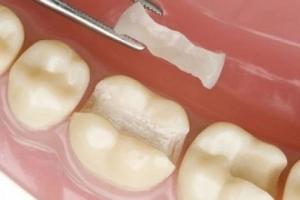 Trám răng có thể gây hại cho răng lân cận không?
