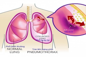 Tràn khí màng phổi điều trị bao lâu?