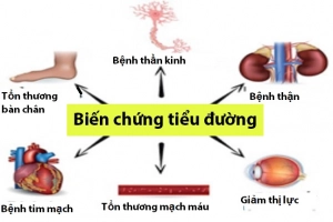 Tránh biến chứng tiểu đường: Nên ăn uống như thế nào?