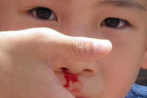 Tránh sặc nếu bị chảy máu mũi khi ngủ