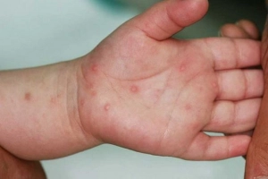 Trẻ bị chân tay miệng nên bôi thuốc gì?