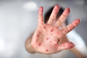 Trẻ có thể mắc tay chân miệng mà không sốt, không phát ban?