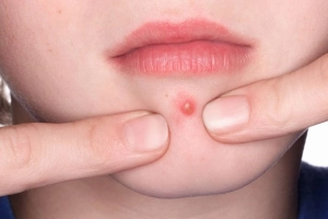 Trẻ dậy thì bị mụn có tự hết?