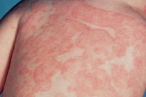 Trẻ dị ứng đạm sữa bò có nguy hiểm không?
