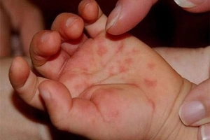 Trẻ hay giật mình khi bị tay chân miệng có phải do biến chứng?