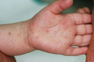 Trẻ mắc tay chân miệng nổi mụn nước nhiều có sao không?