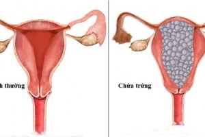 Triệu chứng của thai trứng